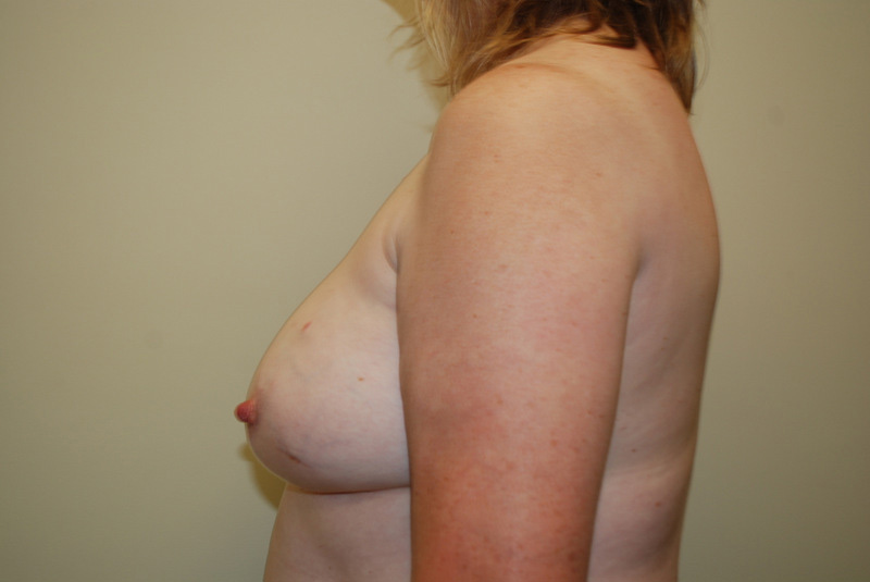 Breast-Reconstruction-Tissue-Expander-13 | Before Breast Reconstruction Tissue Expanders 5