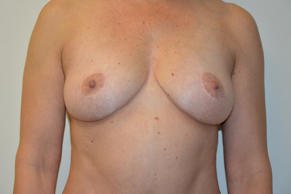 Breast-Lift-13 | After Breast Lift