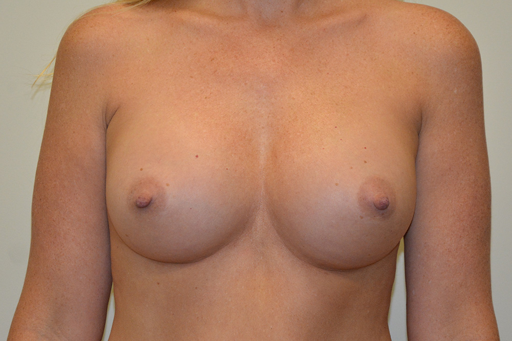 Breast-Augmentation-13 | After Breast Augmentation