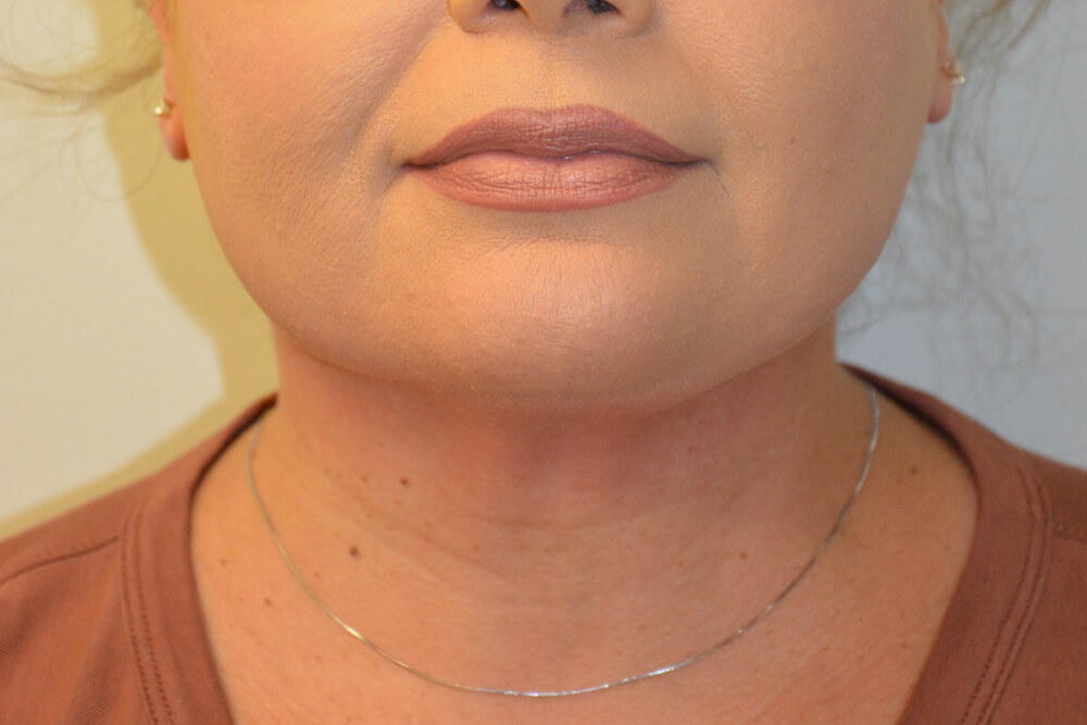Neck-Liposuction-01 | After Neck Liposuction