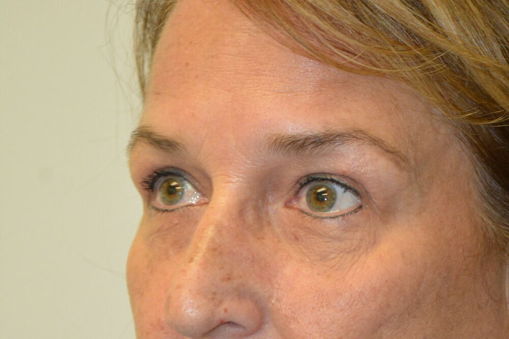 Eyelid-Surgery-13 | After Eyelid Surgery 4