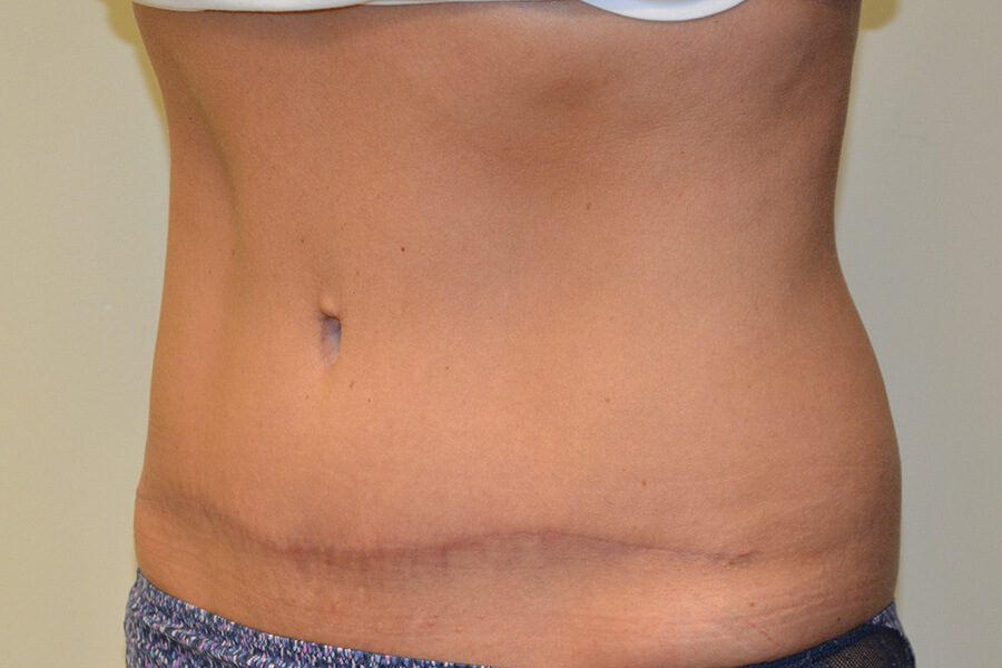 Tummy-Tuck-07 | After Tummy Tuck 4