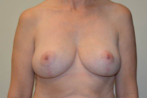 Breast-Reduction-13 | After Breast Reduction