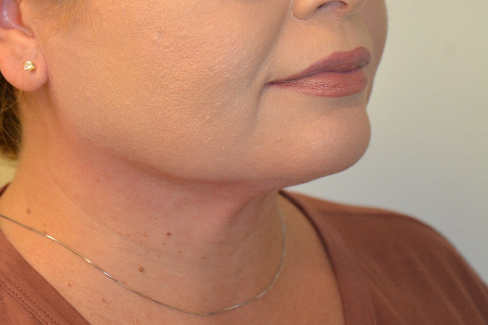 Neck-Liposuction-01 | After Neck Liposuction 2