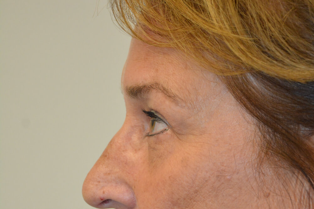 Eyelid-Surgery-13 | After Eyelid Surgery 5