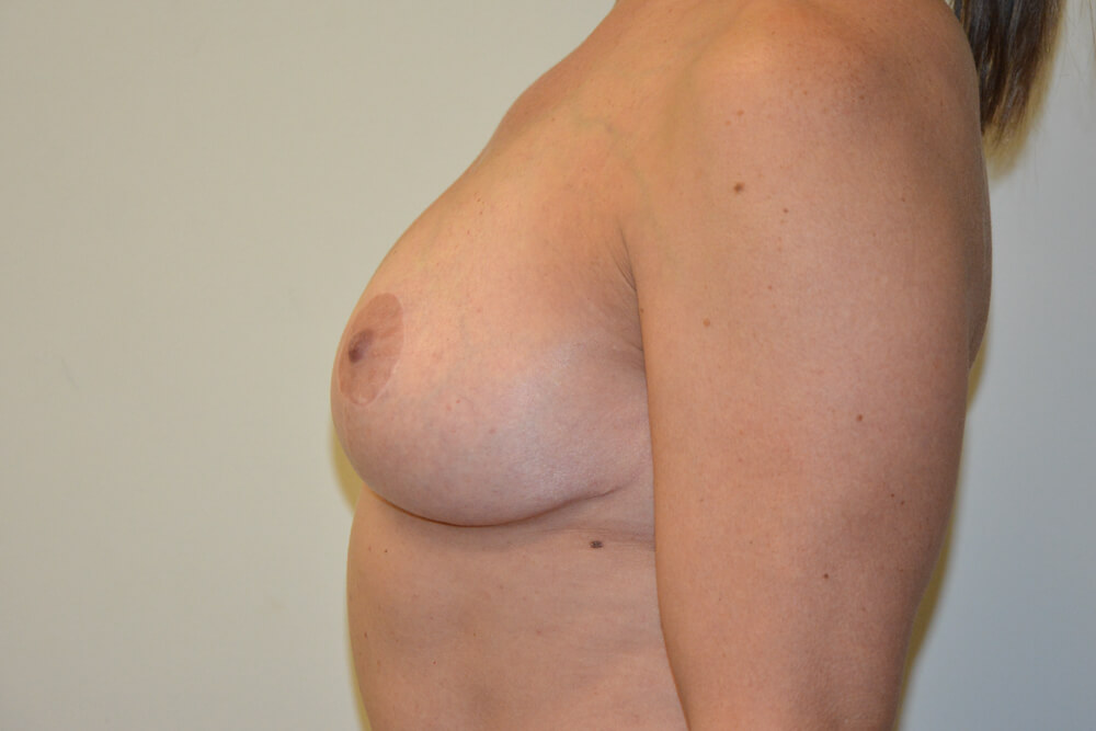 Breast-Lift-13 | After Breast Lift 4