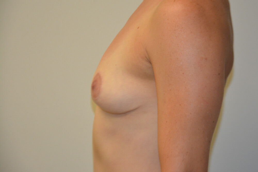 Implant-Removal-12 | After Implant Removal 3