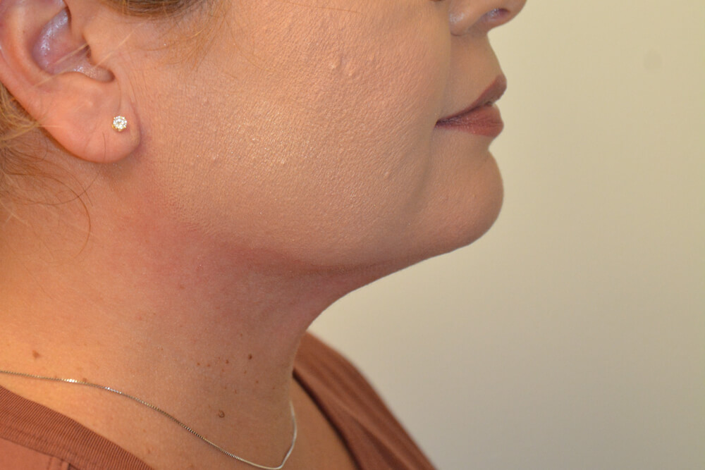 Neck-Liposuction-01 | After Neck Liposuction 3