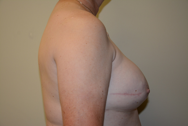 Breast-Reconstruction-Tissue-Expander-13 | After Breast Reconstruction Tissue Expanders 3