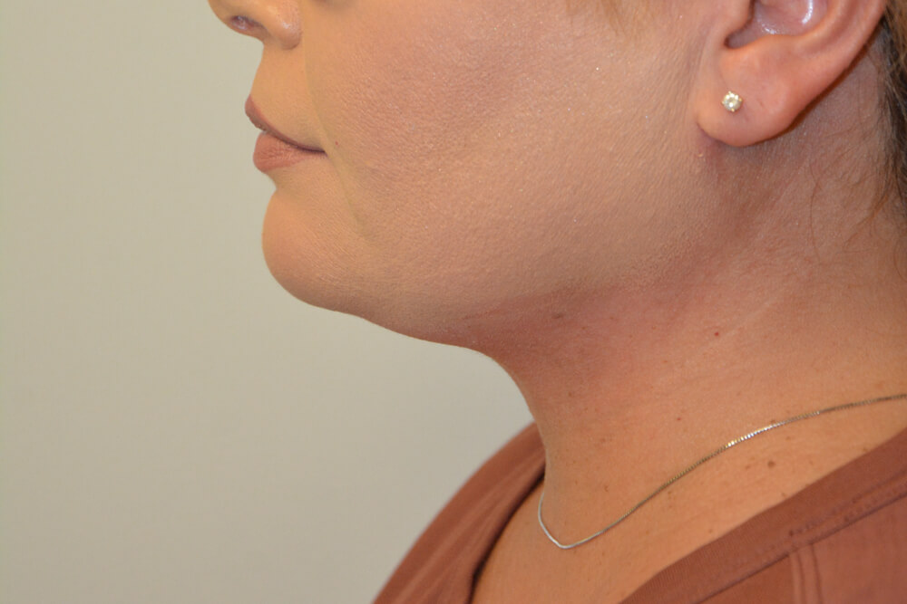 Neck-Liposuction-01 | After Neck Liposuction 5
