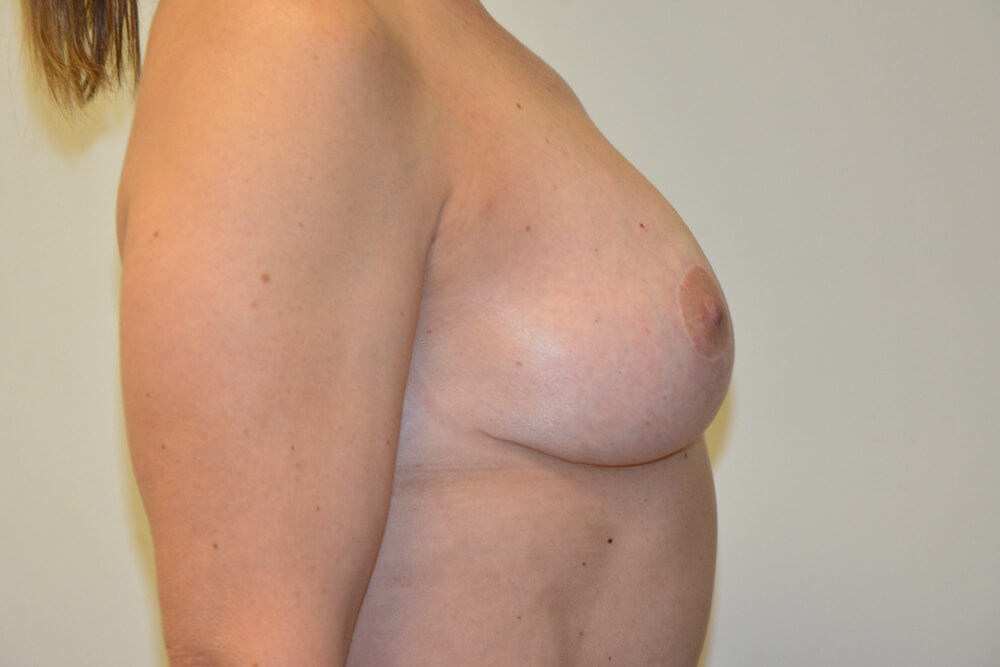 Breast-Lift-13 | After Breast Lift 5