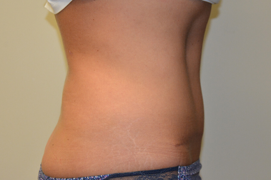 Tummy-Tuck-07 | After Tummy Tuck 3