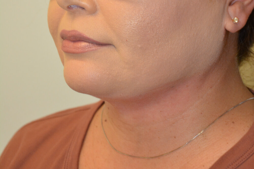 Neck-Liposuction-01 | After Neck Liposuction 4