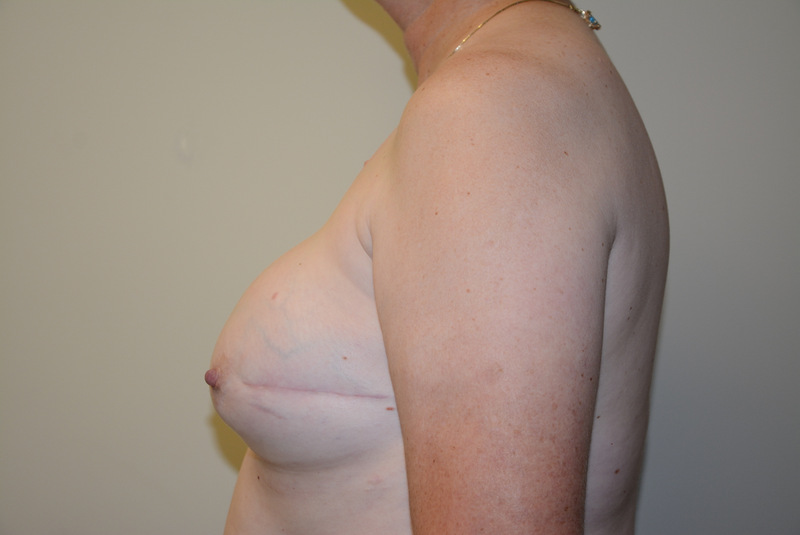 Breast-Reconstruction-Tissue-Expander-13 | After Breast Reconstruction Tissue Expanders 5