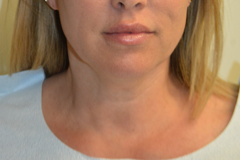 Neck-Liposuction-06 | Before Neck Liposuction