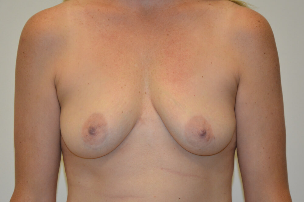Breast-Lift-and-Augmentation-14 | Before Breast Lift and Augmentation