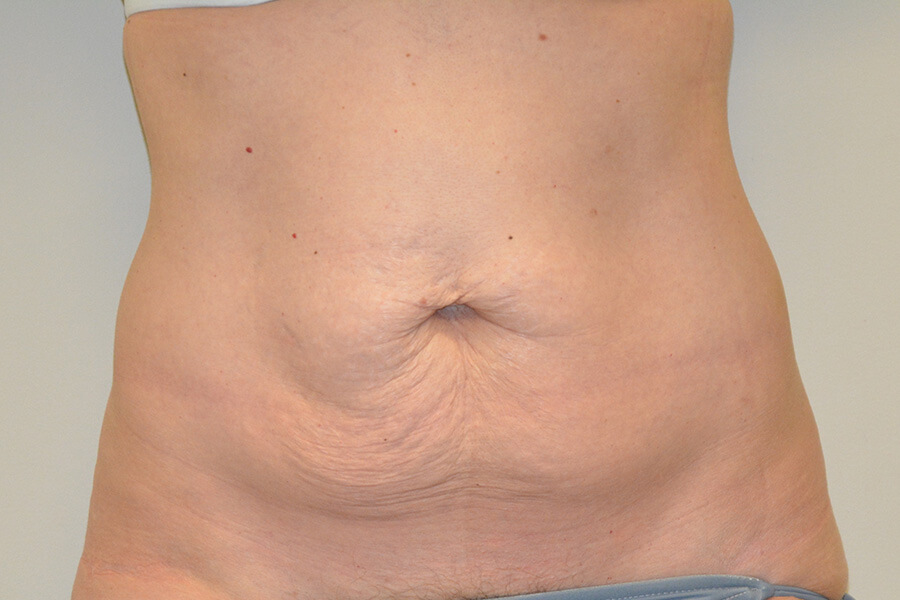 Tummy-Tuck-06 | Before Tummy Tuck