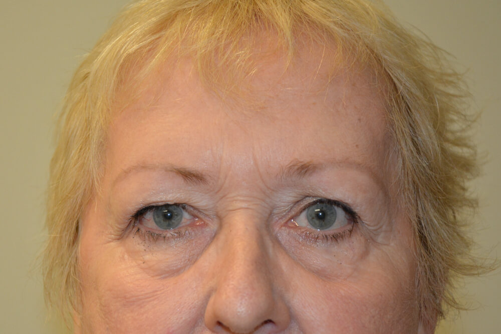 Eyelid-Surgery-14 | Before Eyelid Surgery