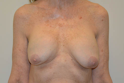 Breast-Revision-14 | Before Breast Revision