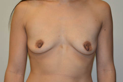 Breast-Augmentation-14 | Before Breast Augmentation 1