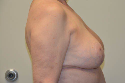 Breast-Reduction-14 | After Breast Reduction 3