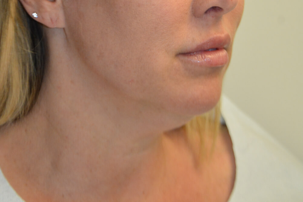 Neck-Liposuction-06 | Before Neck Liposuction 2