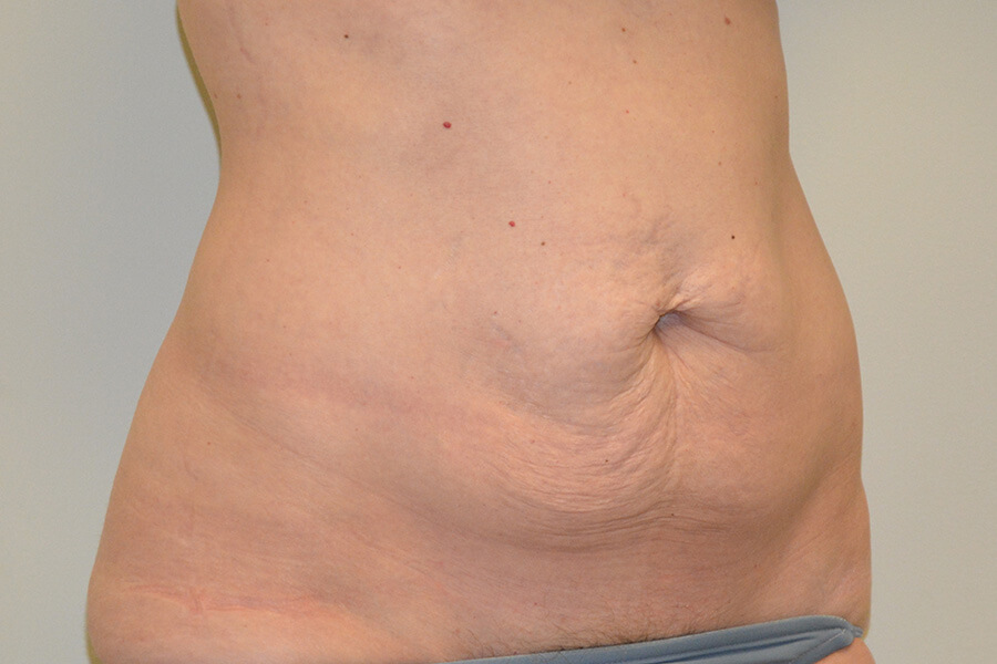 Tummy-Tuck-06 | Before Tummy Tuck 2