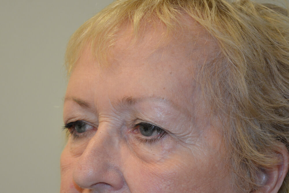 Eyelid-Surgery-14 | Before Eyelid Surgery 2