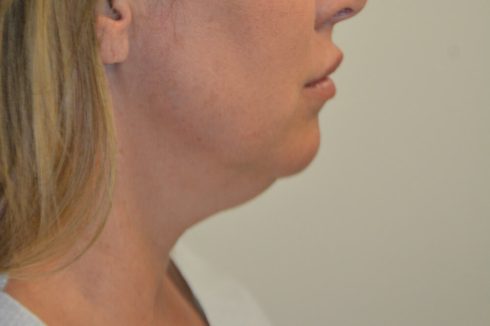 Neck-Liposuction-06 | Before Neck Liposuction 3