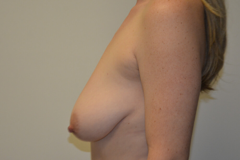 Breast-Lift-14 | Before Breast Lift 3