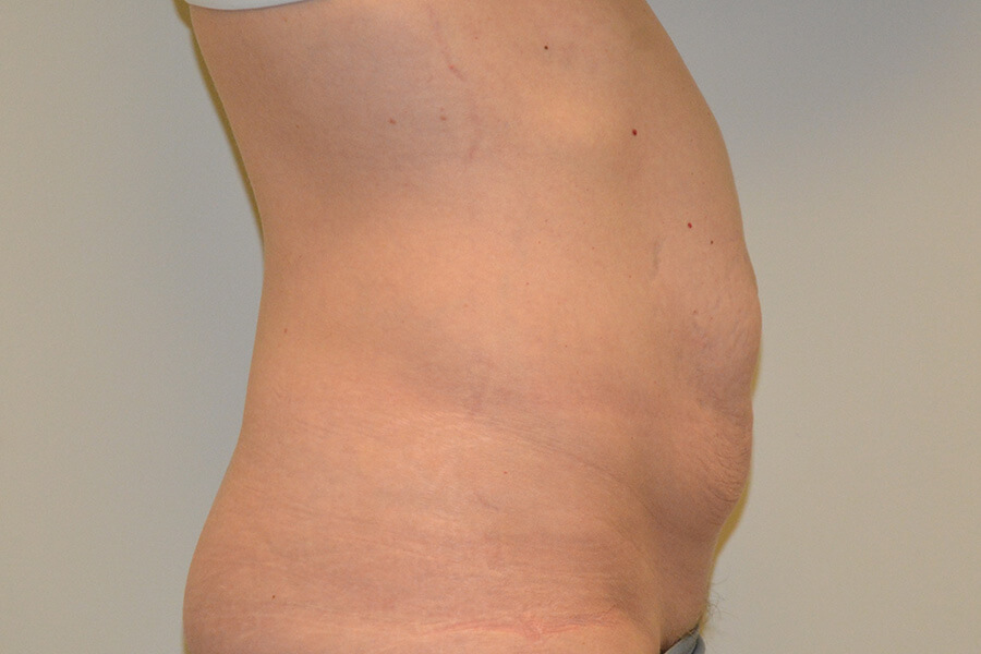 Tummy-Tuck-06 | Before Tummy Tuck 3
