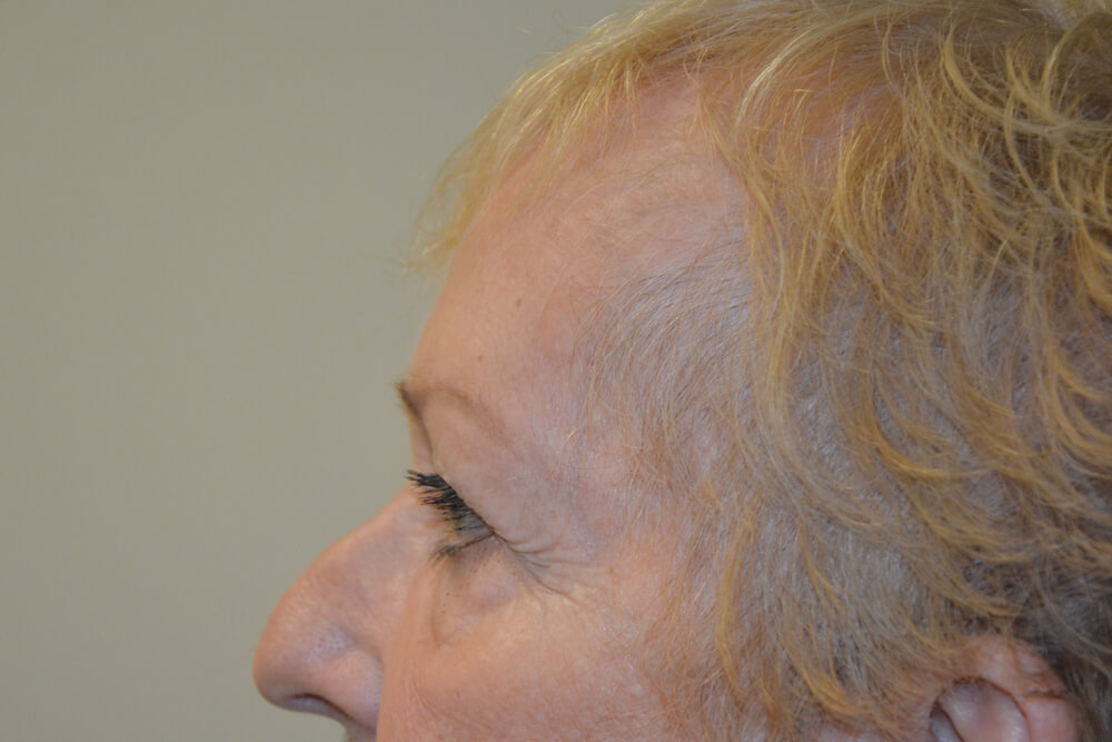 Eyelid-Surgery-14 | Before Eyelid Surgery 3