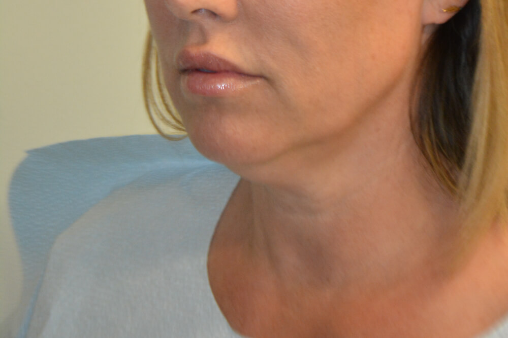Neck-Liposuction-06 | Before Neck Liposuction 4