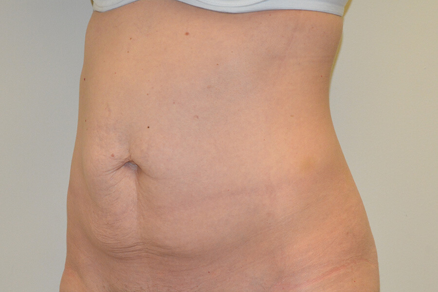 Tummy-Tuck-06 | Before Tummy Tuck 4