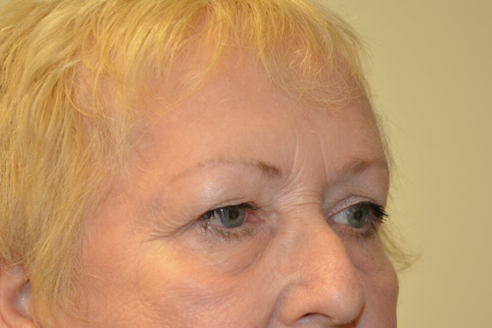 Eyelid-Surgery-14 | Before Eyelid Surgery 4