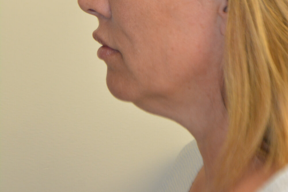 Neck-Liposuction-06 | Before Neck Liposuction 5