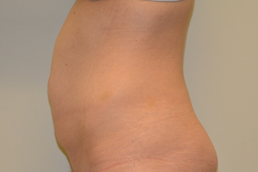 Tummy-Tuck-06 | Before Tummy Tuck 5
