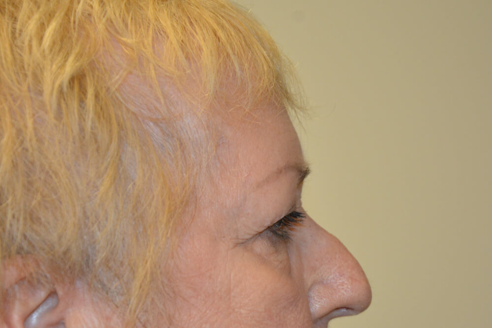 Eyelid-Surgery-14 | Before Eyelid Surgery 5