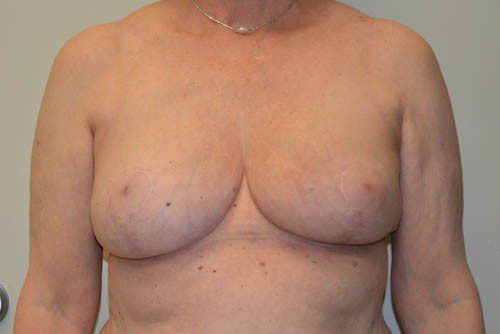 Breast-Reduction-14 | After Breast Reduction