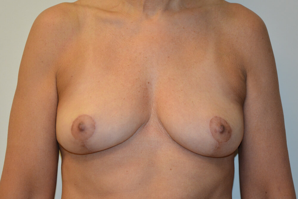 Implant-Removal-14 | After Implant Removal