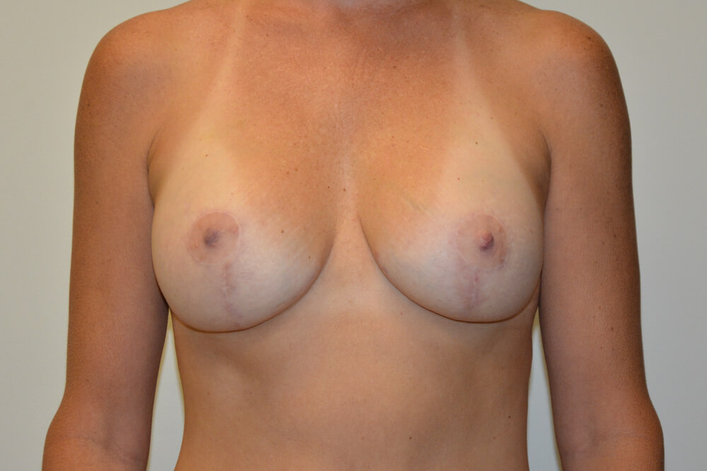 Breast-Lift-and-Augmentation-14 | After Breast Lift and Augmentation