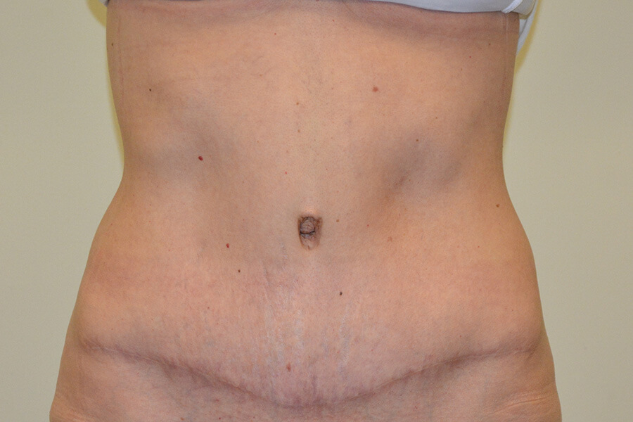Tummy-Tuck-06 | After Tummy Tuck
