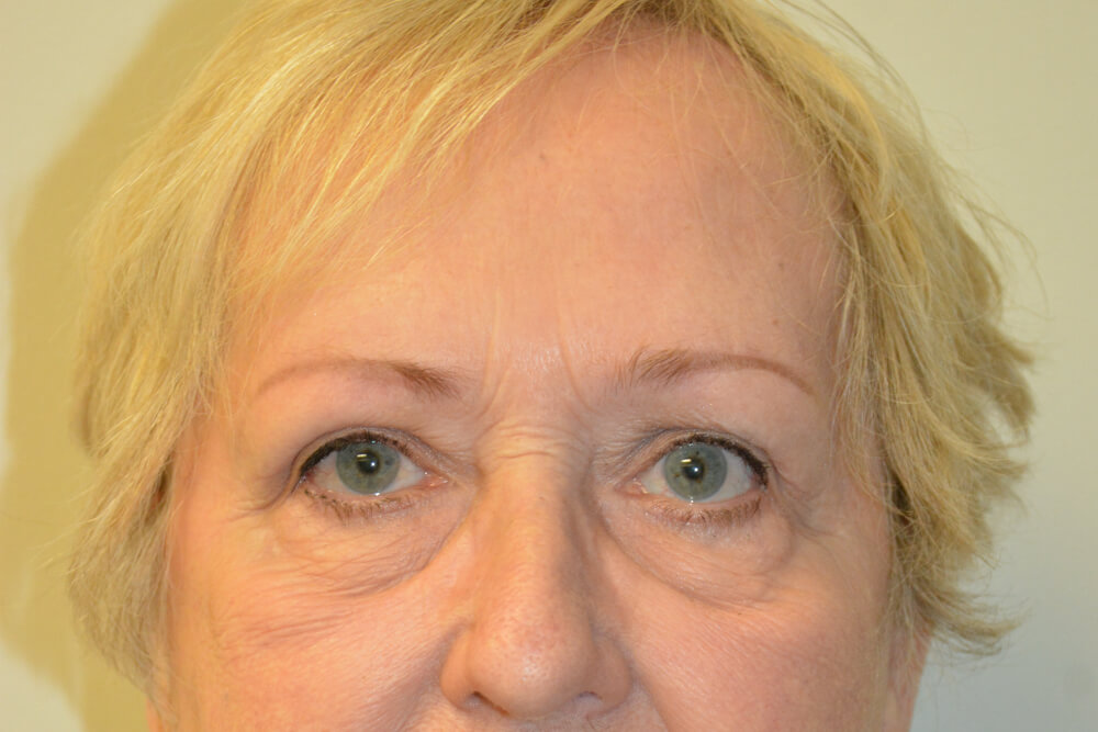 Eyelid-Surgery-14 | After Eyelid Surgery