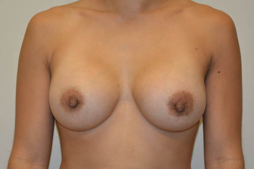 Breast-Augmentation-14 | After Breast Augmentation 1