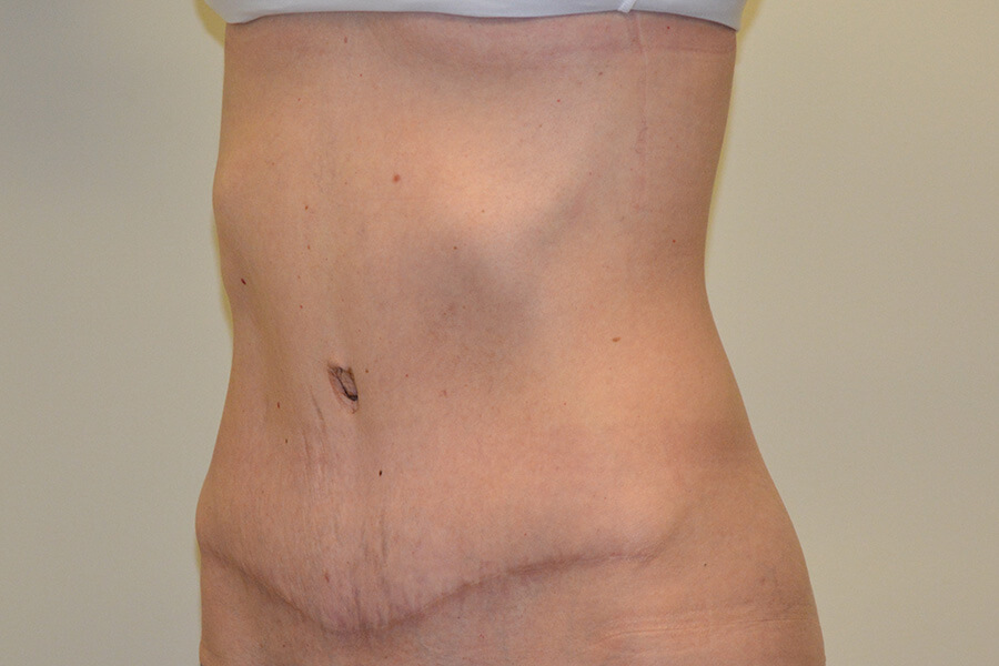Tummy-Tuck-06 | After Tummy Tuck 4
