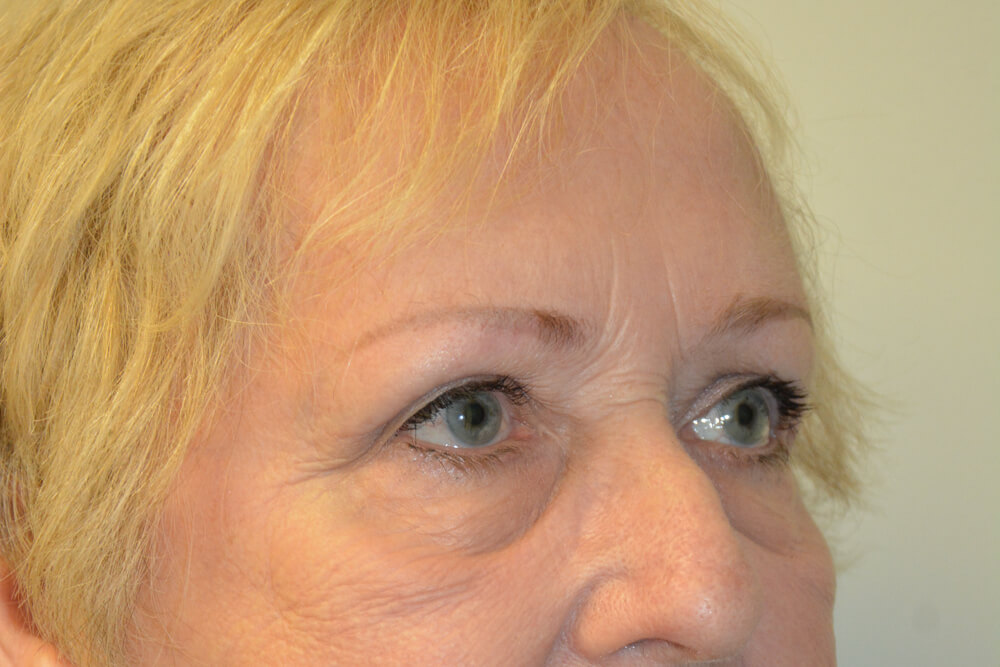 Eyelid-Surgery-14 | After Eyelid Surgery 4