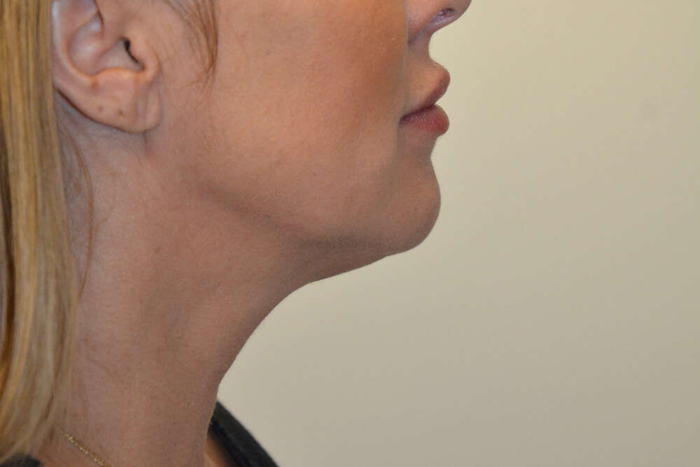Neck-Liposuction-06 | After Neck Liposuction 3