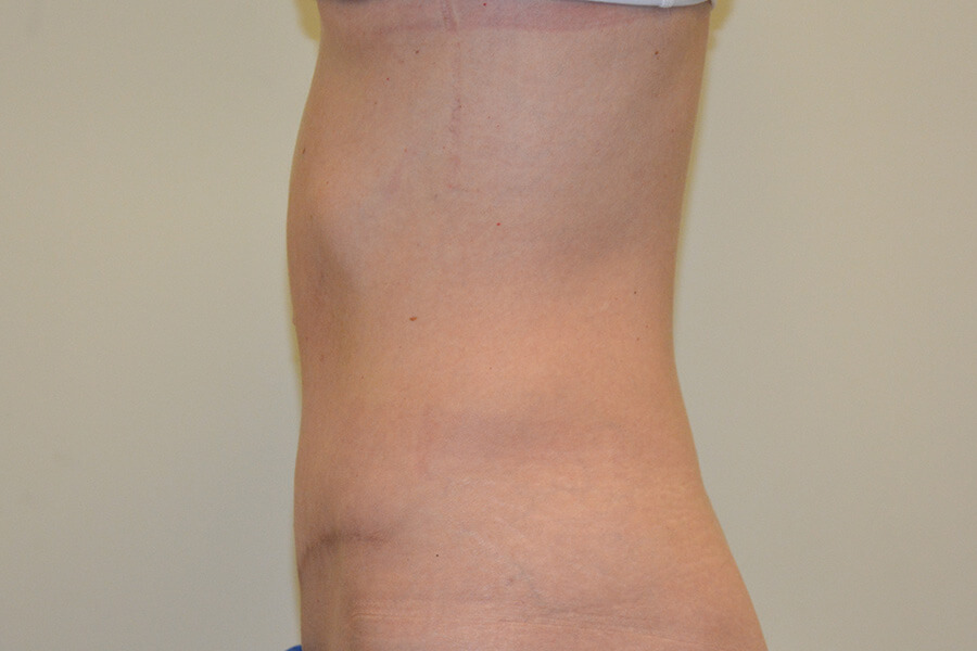 Tummy-Tuck-06 | After Tummy Tuck 5