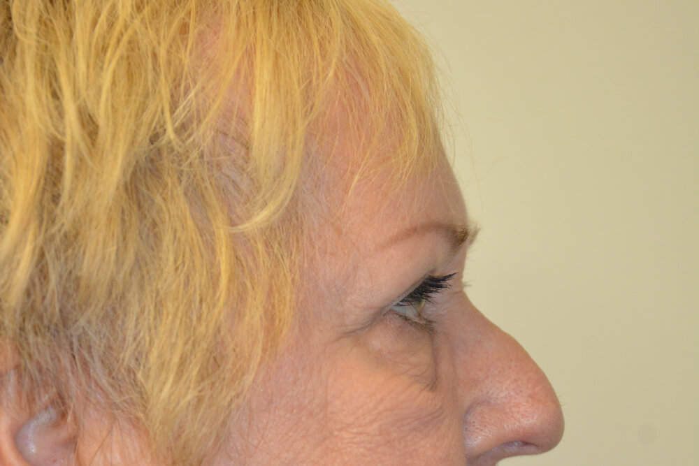 Eyelid-Surgery-14 | After Eyelid Surgery 5