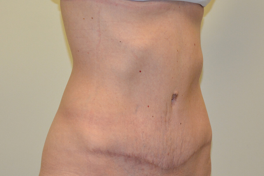 Tummy-Tuck-06 | After Tummy Tuck 2